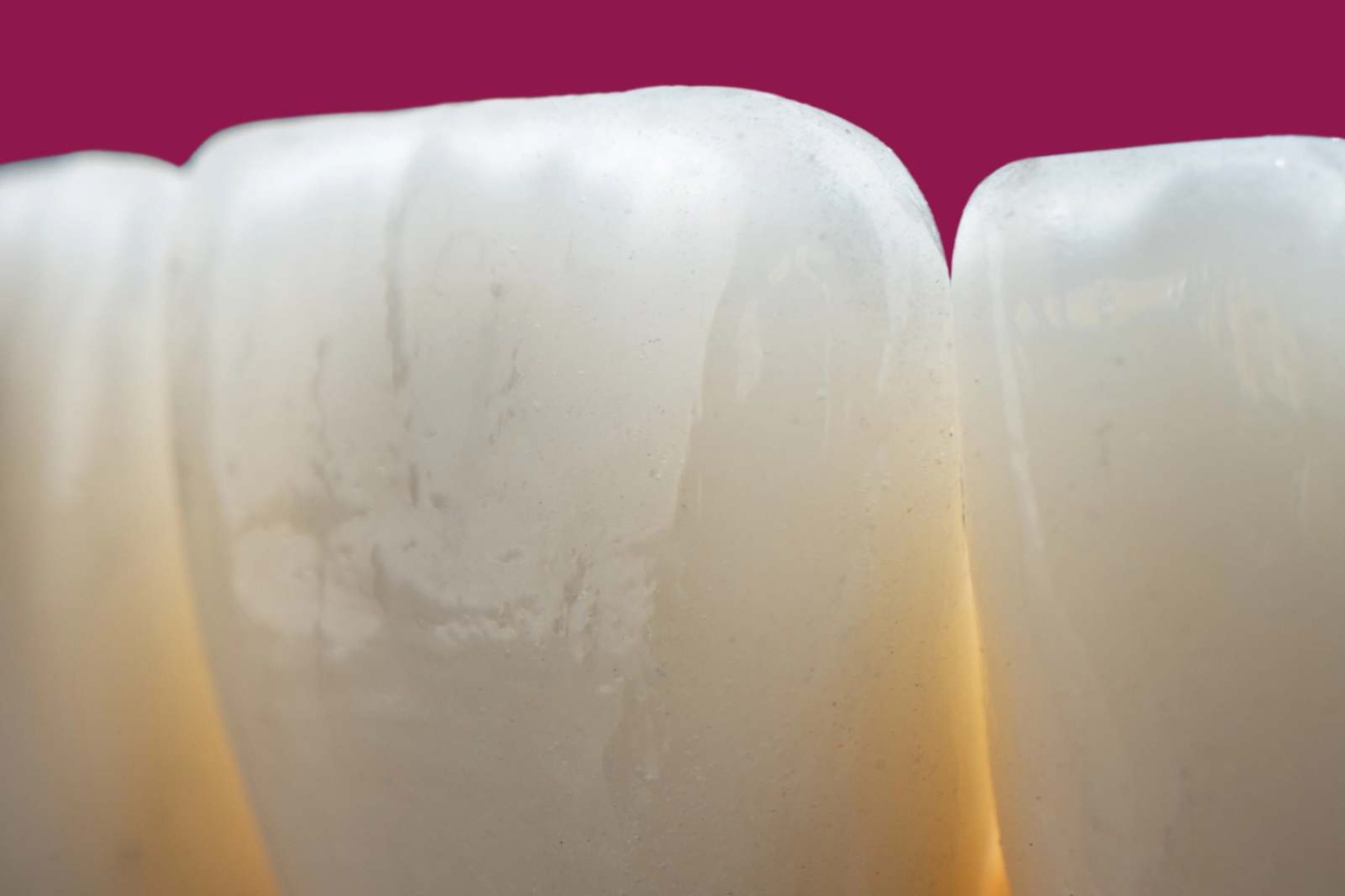 Coroanele dentare din zirconiu – prepararea dintelui, fabricare, estetică